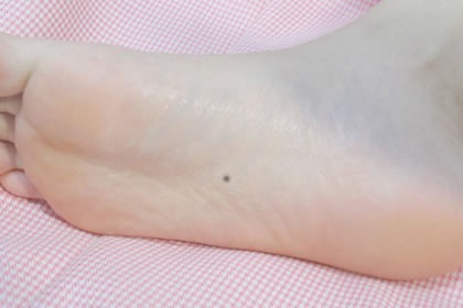 痣相解析脚底的痣 脚底有痣代表什么意义